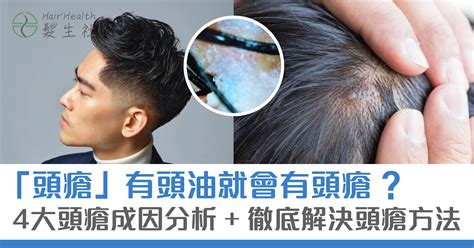 頭上生瘡|點解會有頭瘡？了解成因、治療及有效解決方法